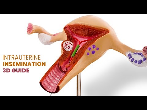 Intrauterine Insemination (IUI) for Pregnancy | Step by Step Guide | 3D Animation