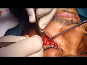 FRACTURE OF THE ZYGOMA OPEN REDUCTION.BY PROF. RIDA FRANKA.