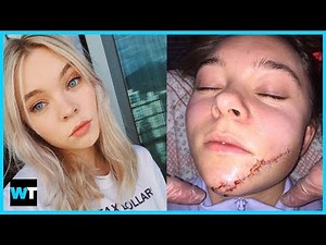 Taylor Hickson Sues Over GRUESOME Facial Injury | What's Trending Now!
