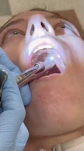 Anterior Middle Superior Alveolar (AMSA) Injection #dentist #localanesthesia #injection #amsa