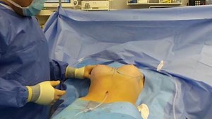 The Doctor Demonstrates a TUBA Breast Augmentation With No Visible Scars