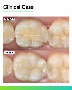 Watch this replacement of a composite restoration by Dr. Gunnar Reich! ​A patient needed a replacement of a fractured composite on the first lower molar. Impression was made with 3M™ Impregum™ Penta™ Super Quick Medium Body Polyether Impression Material in the monophase technique. ​ ​ Refer to Instructions for Use (IFU) for complete product information. | Solventum Dental | Facebook