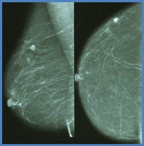 U.S. Women’s Awareness of Breast Density Varies by Race and Ethnicity, Education and Income, Mayo Clinic Study Finds - Mayo Clinic News Network