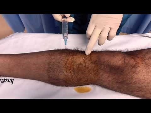 Saphenous Nerve Block - Below the Knee Field Block by Henry Hu, MD