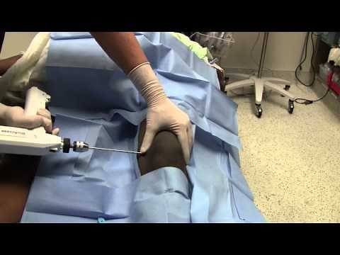 Hip Dislocation Reduction