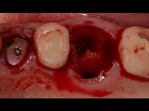 Extractions and Immediate Implant-Upper premolar and molar