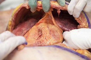 „Resuscitative thoracotomy“ was ist das und wann braucht man das?