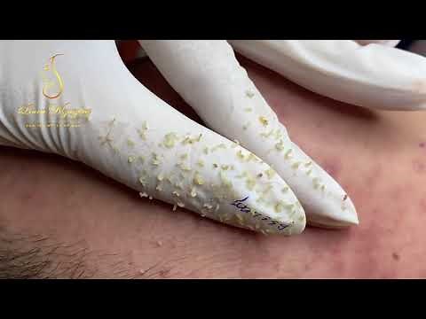 Blackheads removal (339) | Loan Nguyen