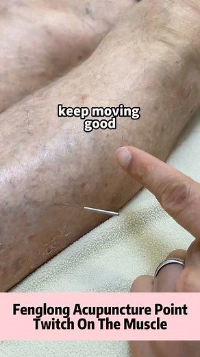 When inserting a needle into the Fenglong acupuncture point, it may cause the needle to twitch on the muscle. This is a common phenomenon in acupuncture therapy, indicating that the needle has stimulated the nerves or muscles in the area. It is important to note that this twitching sensation may vary from person to person and from acupoint to acupoint, depending on the individual‘s sensitivity and the location of the acupoint. During acupuncture treatment, it is recommended to relax the body and