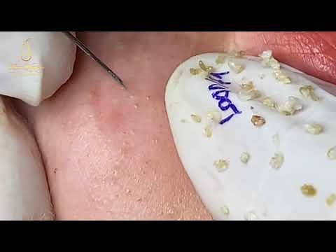 Remove many blackheads and whiteheads (171) | Loan nguyen