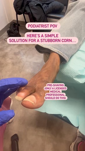 Permission given to post. ⁣ ⁣ This patient came in with a very painful, stubborn corn. It was causing him to limp. This is a soft tissue lesion that forms due to rubbing or friction. His cause was the bunion (the big toe) that was leaning into the second toe. This combined with tight shoes caused the skin to become irritated, leading to the corn. ⁣ ⁣ Most likely causes: tight/narrow shoes, bunions or hammertoes, friction. ⁣ ⁣ Treatment: I shaved it down (please seek medical treatment from a podi