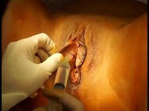 Labiaplasty surgery (labia minora reduction) by Dr. Daniel A. Medalie of Cleveland Plastic Surgery