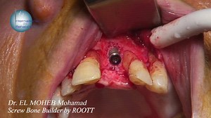 ROOTT implant placement using ROOTT screw bone builder + MPM | International group for Oral Rehabilitation