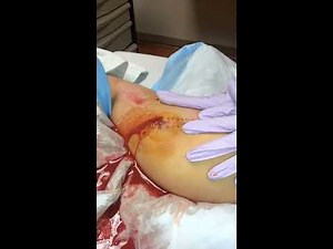 Puss and blood shooting out of my infected leg