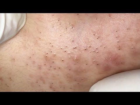 A LOT OF BLACKHEADS ON THE JAWLINE | Suri Job 145
