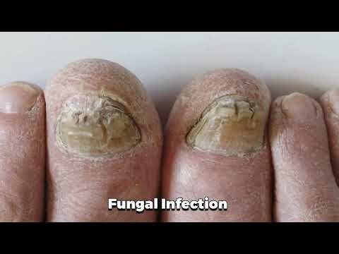 FIX FUNGAL NAILS FAST!!! Clear Your Toenails With This One Simple Trick!!