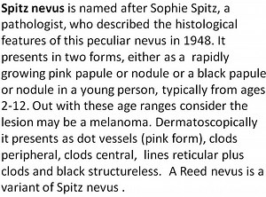 Spitz Nevus