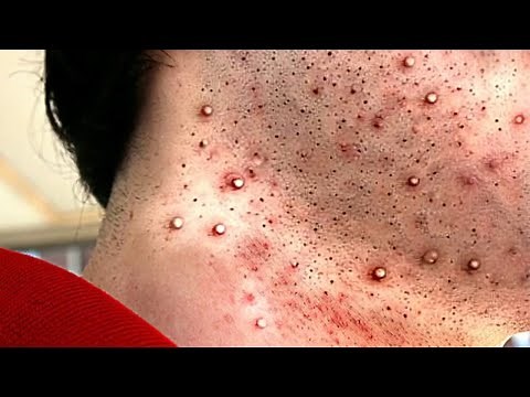 GOLDMINE !! Ultimate POPPING Removal #14 - NEW Pimple Popping 2020