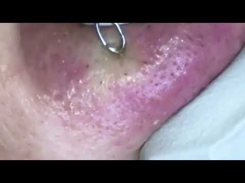 Blackheads Be Gone: Long-Lasting Removal Tips & Tricks ‪@removeblackhead‬