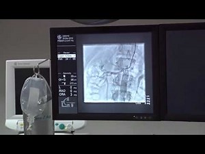 Renal Angiogram through Radial Artery | A live demonstration