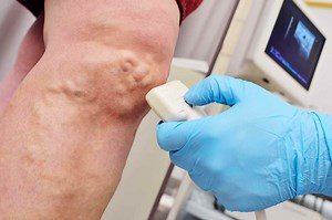 Venous Reflux | Venous Insufficiency | Vein Clinic Perth