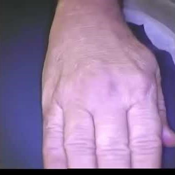 ICG Lymphography (arm) © - Margarita Correa MD, CLT