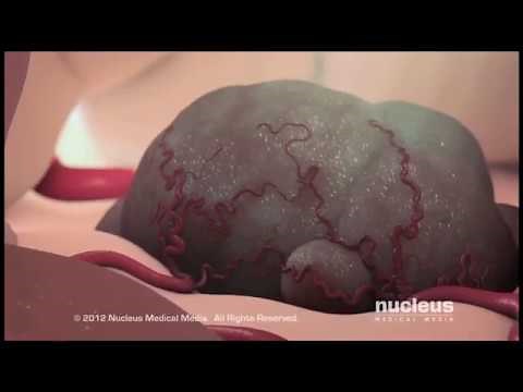 Cancer & Chemotherapy at Cook Children's