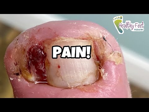 SHOCKING VIDEO OF THE MOST EXTREME INGROWN TOENAIL OF 2020!