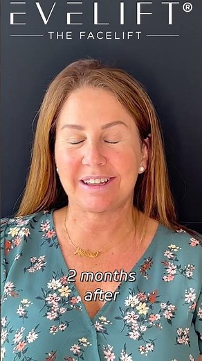 Patient Testimonial 2 Months After EVE Lift™ | Eden Plastic Surgery: Dr. Ali Charafeddine, MD