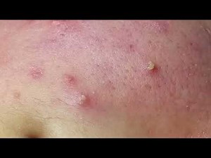 Severe Acne - Part I
