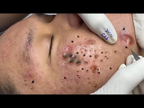 𝐄𝐱𝐭𝐫𝐞𝐦𝐞 𝐁𝐥𝐚𝐜𝐤𝐡𝐞𝐚𝐝 𝐑𝐞𝐦𝐨𝐯𝐚𝐥 𝐒𝐚𝐭𝐢𝐬𝐟𝐲𝐢𝐧𝐠 𝐑𝐞𝐥𝐚𝐱𝐢𝐧𝐠 #8845