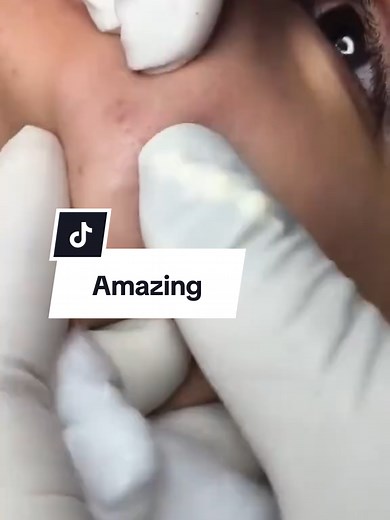 Satisfying Pimple Pop Compilation — Amazing Relaxing Videos