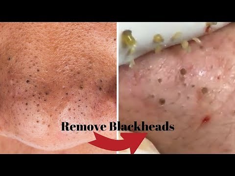 Remove Your Blackheads using these Techniques Naturally! Home Remedies