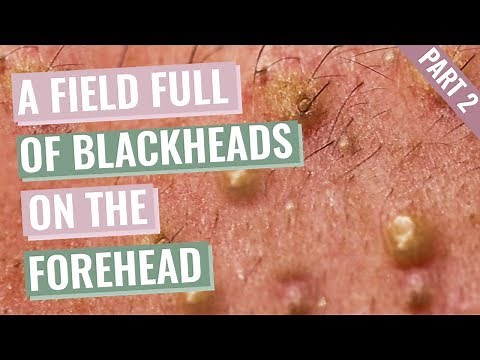 A Field Full of Blackheads on Aimilios’s Forehead and eyebrows - Part 2 out of 4