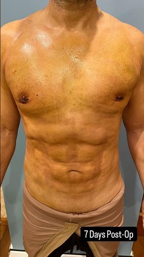 Pre-Op/1 Day Post-Op/3 Days Post-Op/7 Days Post-Op #body #male #beforeandafter #results #aesthetic