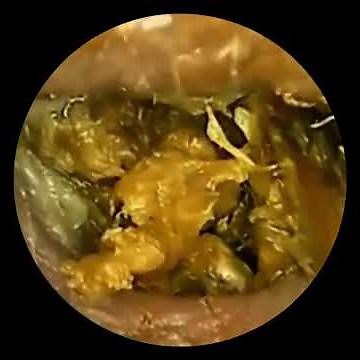 EP1 MASSIVE EAR WAX REMOVAL