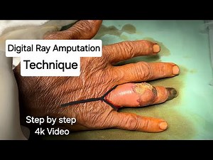 Digital Ray Amputation Technique - Dr Tayyab Riaz Ch
