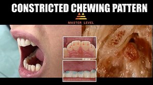 „Doctor, I have a clicking joint ! And it hurts!” There are many reasons for disc displacement but premature contacts that shift the jaw bacward for sure predispose to TMD. In my practise I see it mostly after orthodontic treatment therefore it is crucial to do it with respect to TMJ. More about proper condyle position in long „augumented reality” webinar in 2 weeks ! www.master-level.pl/en #temporomandibularjointdisorder #masterlevel #dentistry #temporomandibularjoint #lukas_lassmann | Lukas La