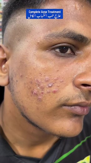 Whatsapp 0304-021-0941 Glow & Clean Complete Acne Treatment | Glow & Clean by Ameen | Facebook