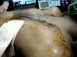 Medical Tube- Flail Chest