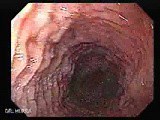 Eosinophilic Esophagitis - Linear Furrows • Video • MEDtube.net