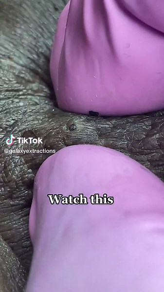 #pimplepop #cystpopping #galaxyextraction #extractionsatisfaciton #pimplepopperaddict