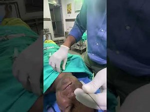 Retrograde nasal intubation