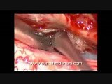 Spinal Cord Tumor - Spinal Intradural Meningioma - Microsurgical Excision • Video • MEDtube.net
