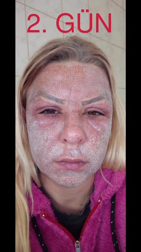Plazma Pen: Tüm Aşamalara Yosun Peeling Kılavuzu