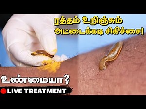 Leech Therapy - அட்டைய கடிக்க விட்டு சிகிச்சையா?😱 | This is how Leech Therapy Done | Live Treatment