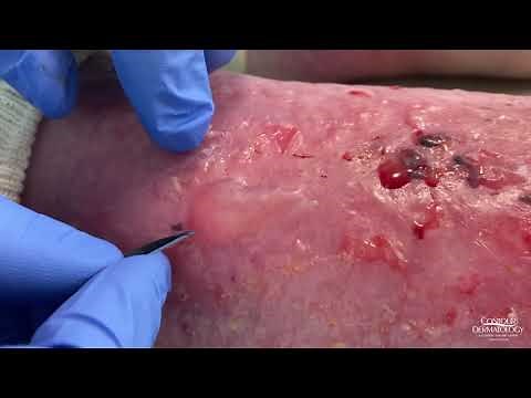 Dermatologist Popping Blisters | CONTOUR DERMATOLOGY