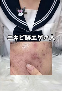 ニキビ跡改善法で美肌を手に入れる！