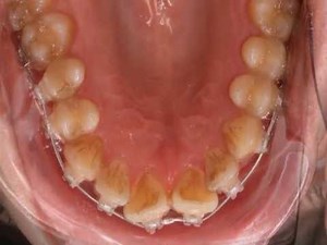 Buck teeth before and after braces