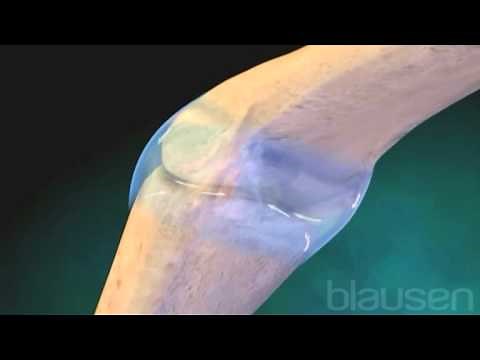 Artritis reumatoide (AR)